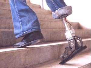 Una de las tantas prótesis de pie que existen. La nueva prótesis mejora el caminar del paciente.