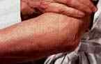 La psoriasis, una enfermedad que afecta a casi 800 mil argentinos, se manifiesta como una inflamación de la piel.